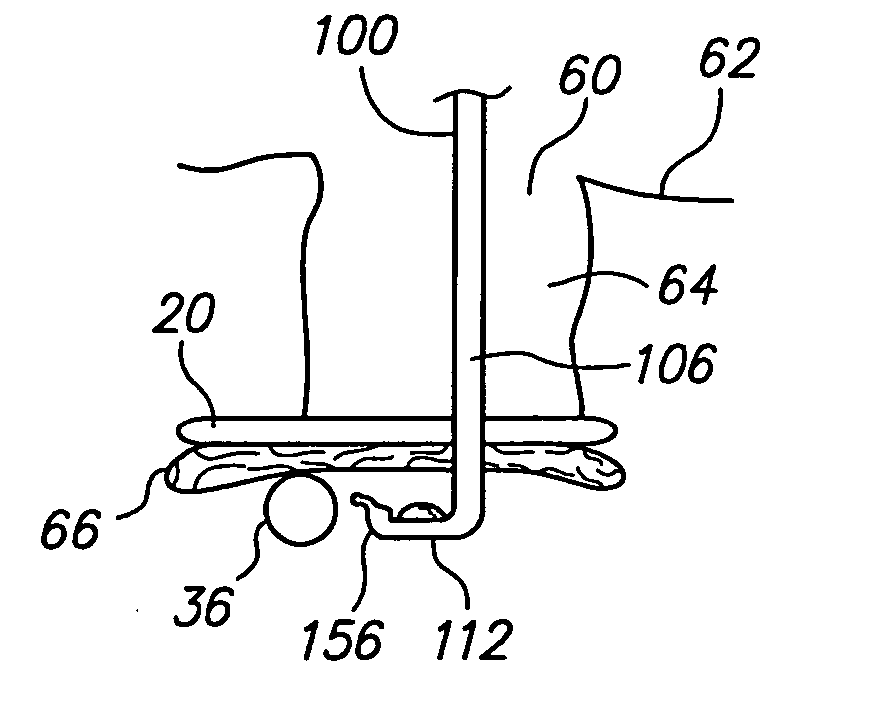 Tissue removal probe with sliding burr in cutting window