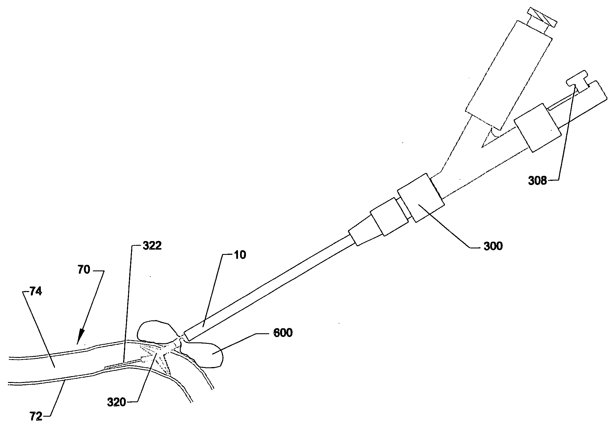 Method and apparatus for percutaneous wound sealing