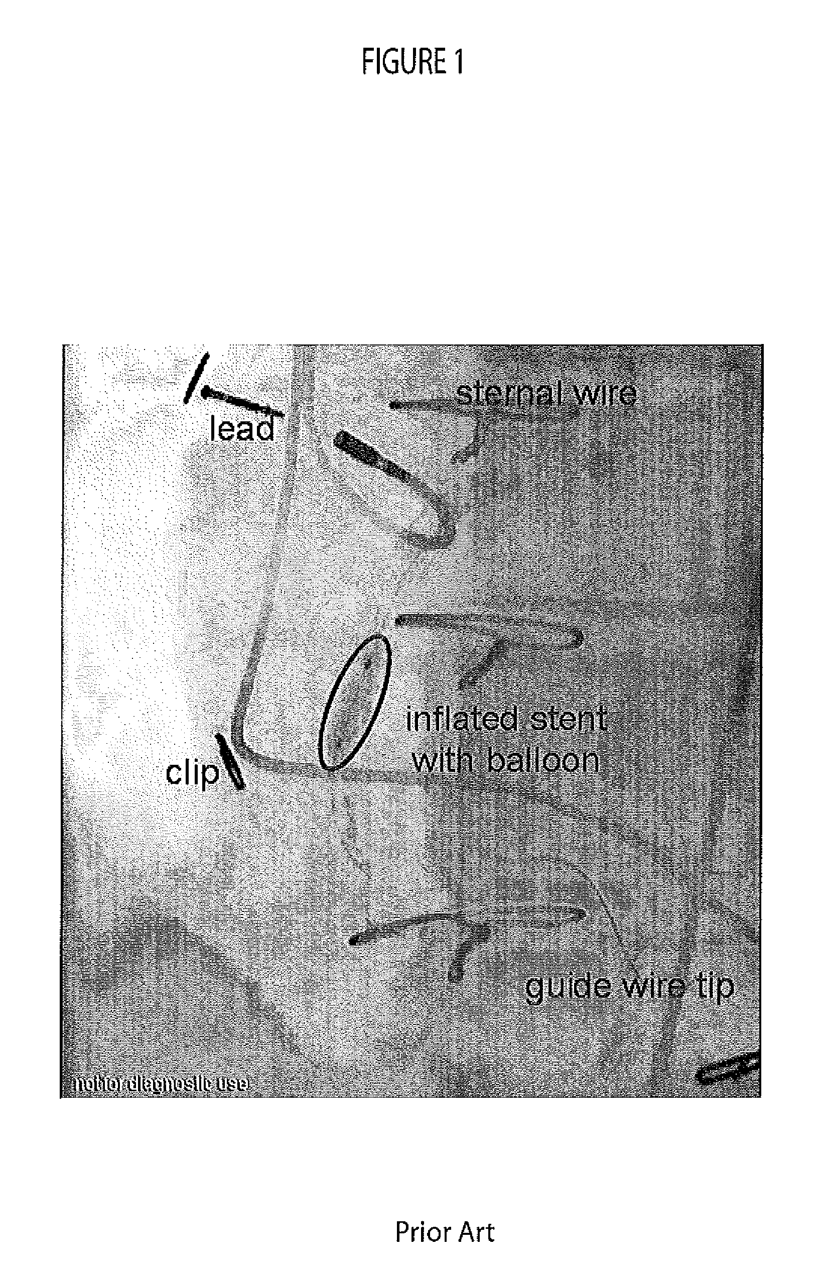 System for detecting catheterization devices