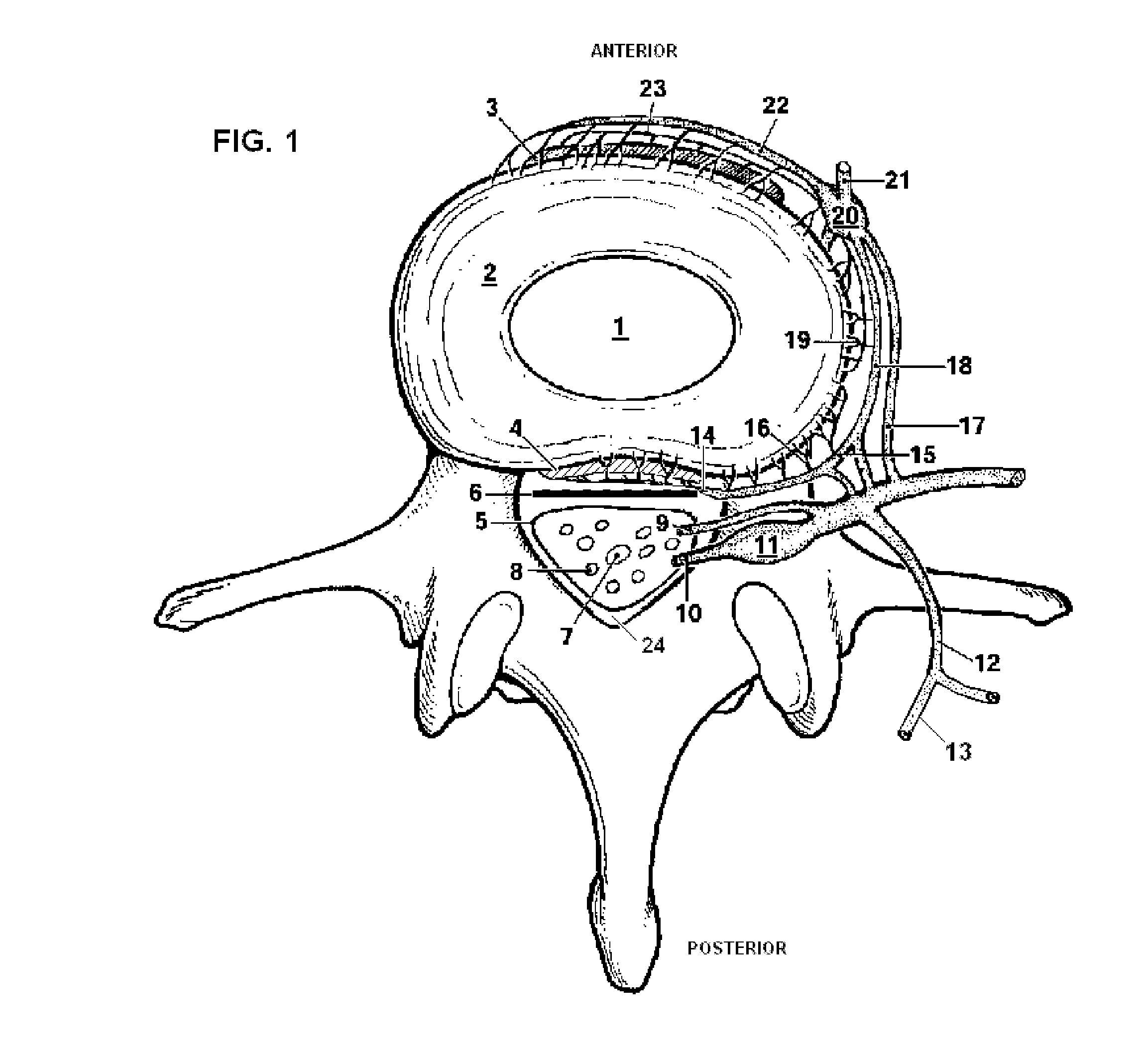 System and Methods for Diagnosis and Treatment of Discogenic Lower Back Pain