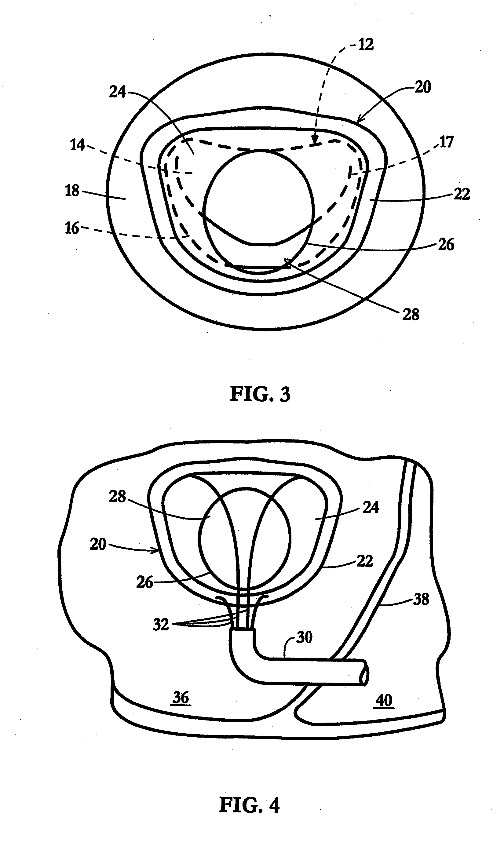 Device and Method for Temporary or Permanent Suspension of an Implantable Scaffolding Containing an Orifice for Placement of a Prosthetic or Bio-Prosthetic Valve