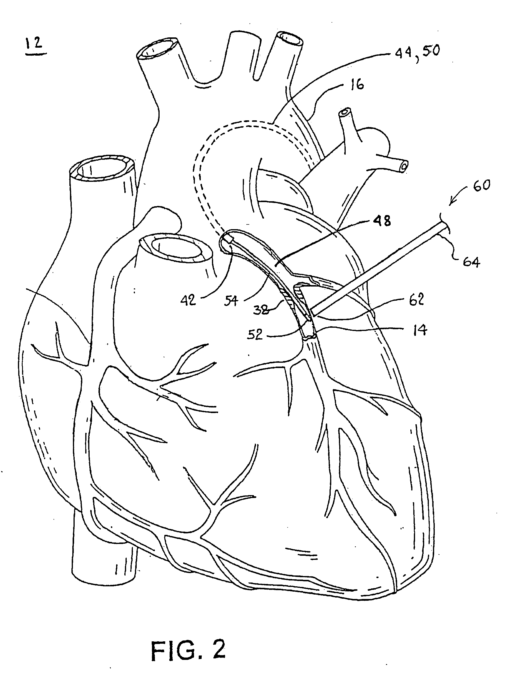 Methods and Apparatus for Locating Body Vessels and Occlusions in Body Vessels