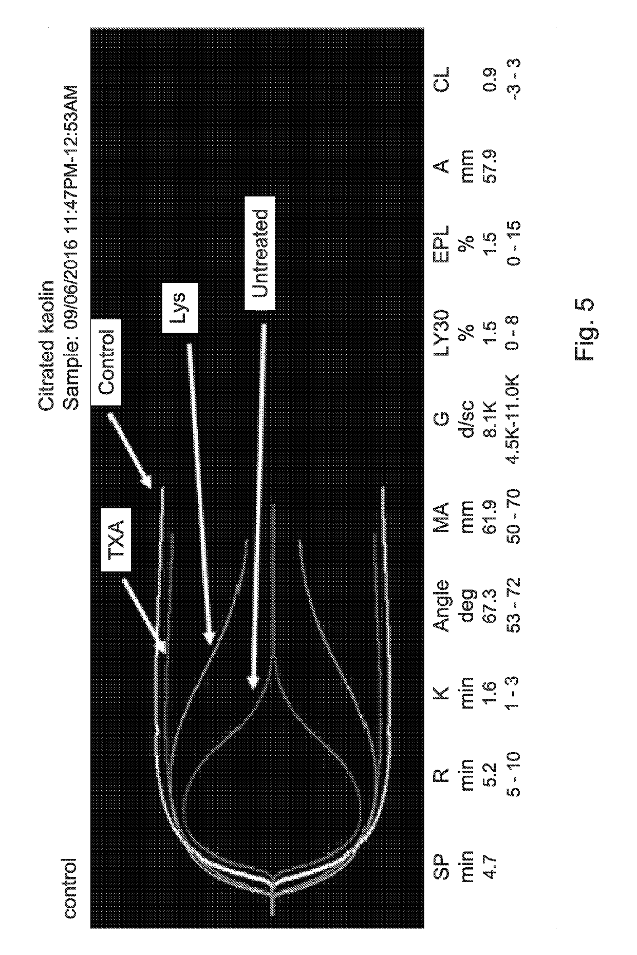 Human blood-derived products having decreased fibrinolytic activity and uses thereof in hemostatic disorders