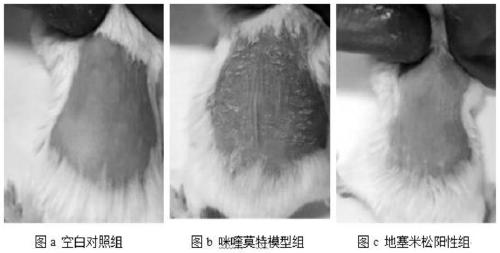 Application of acetamide in anti-psoriasis drugs