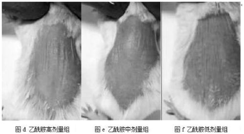 Application of acetamide in anti-psoriasis drugs