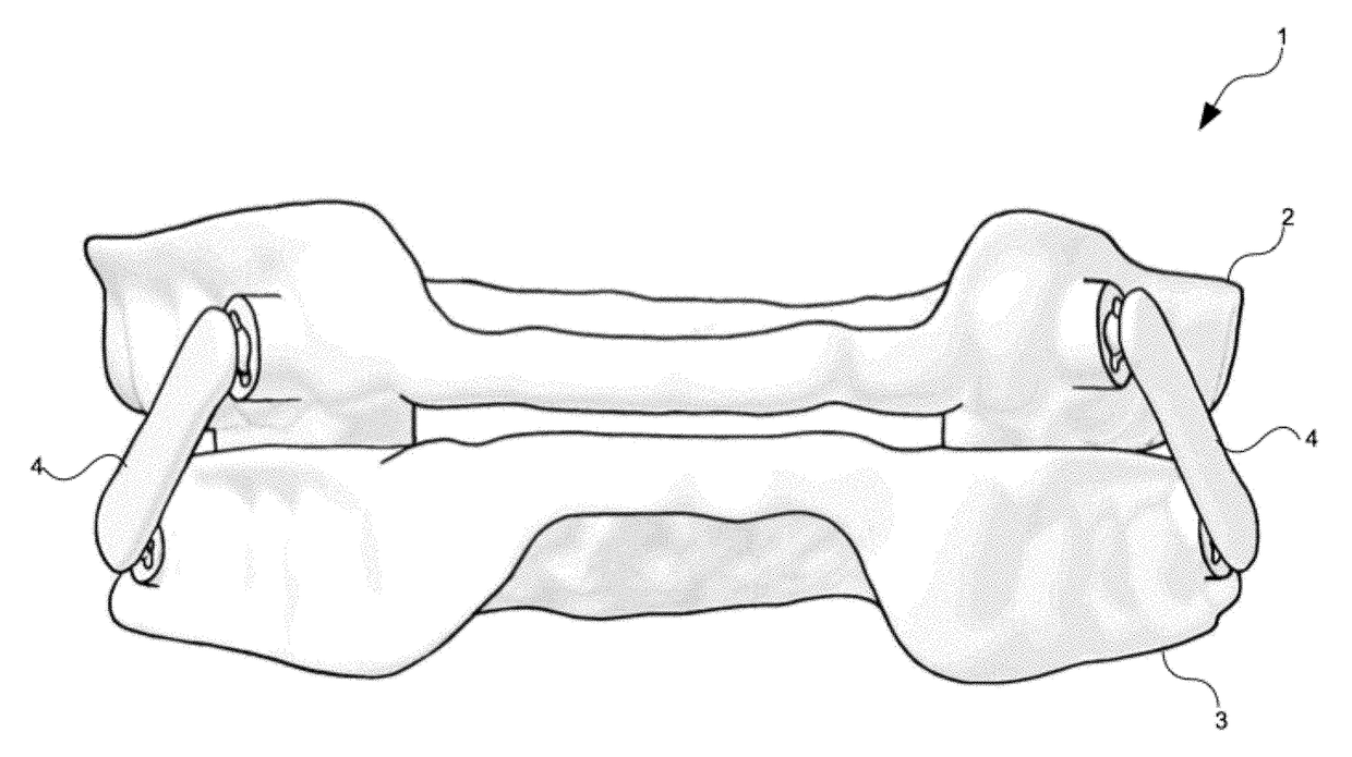 Intraoral Orthosis for Mandibular Advancement for Snoring and Obstructive Sleep Apnea