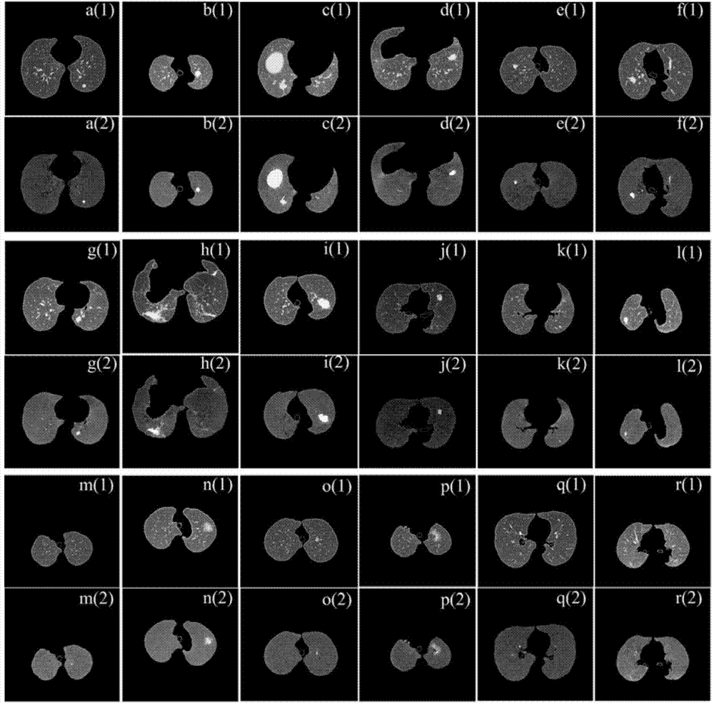 Automatic segmenting method for lesion tissue in lung CT image