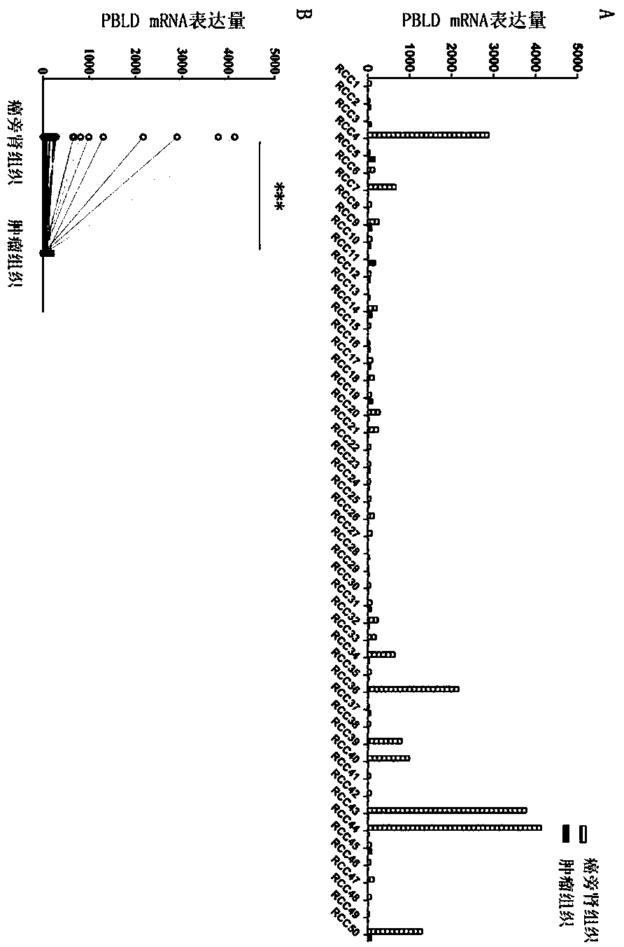 Application of PBLD gene in preparation of medicine for diagnosing renal clear cell carcinoma and predicting prognosis of same