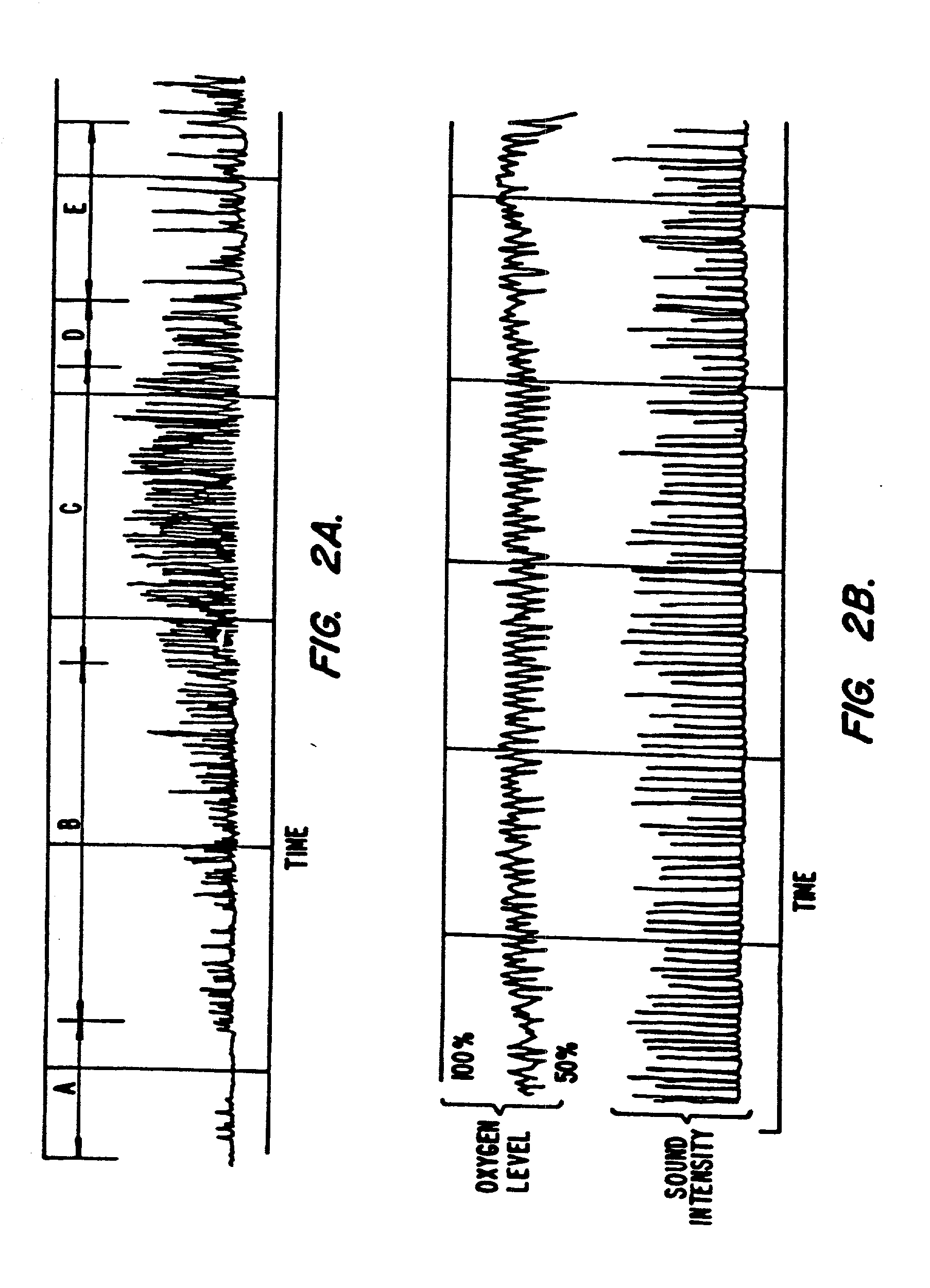 Method and apparatus useful in the diagnosis of obstructive sleep apnea of a patient