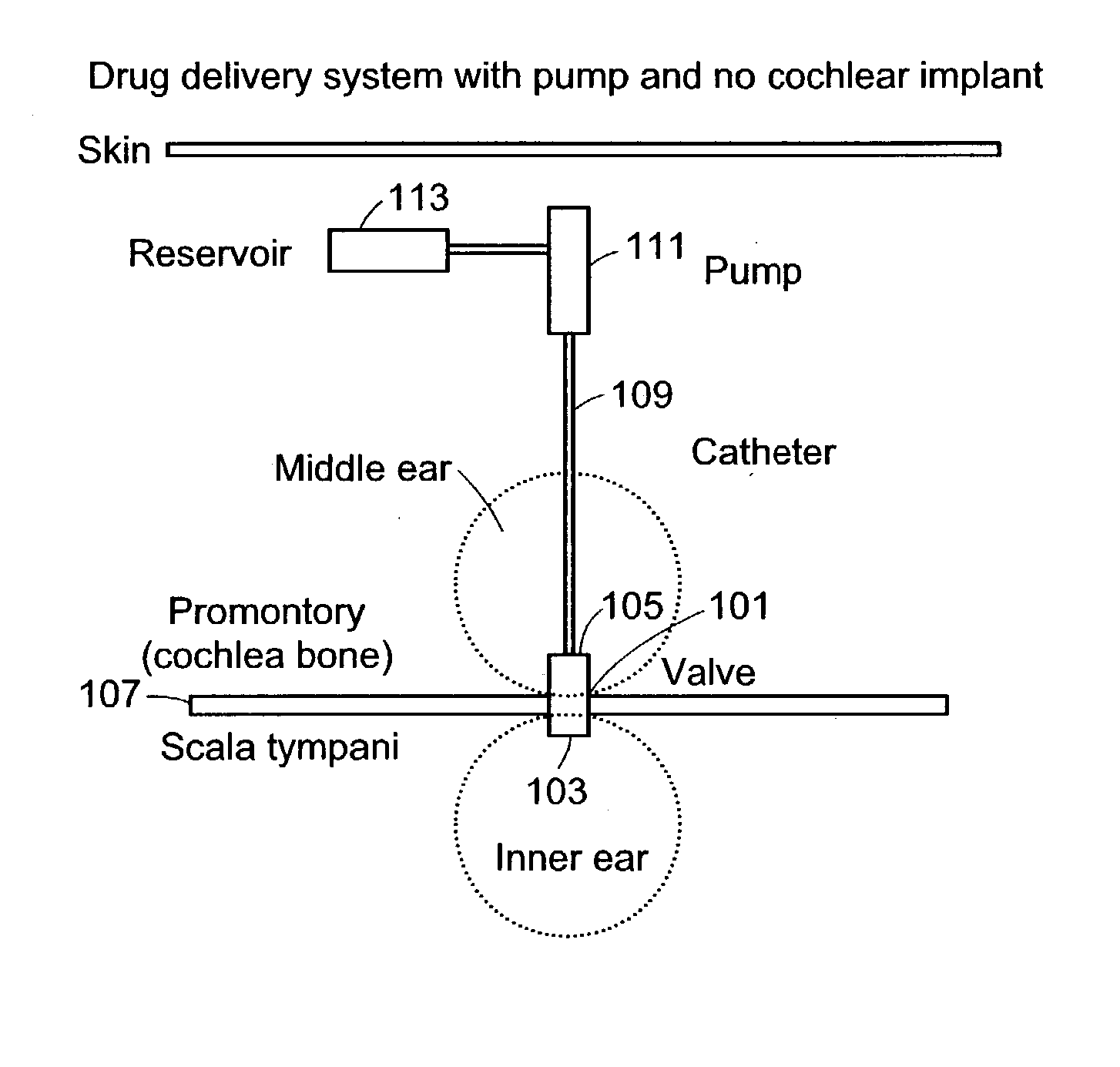 Implantable fluid delivery apparatuses and implantable electrode