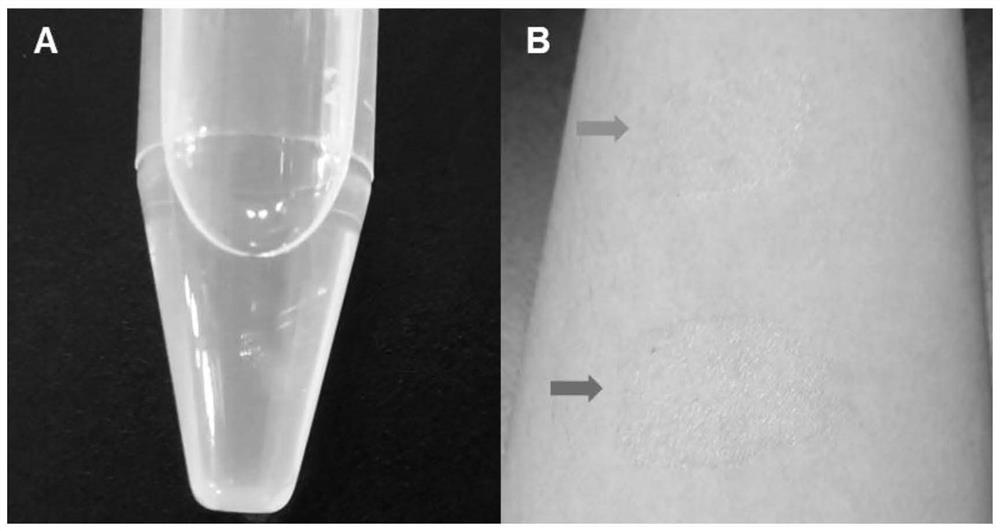 Myricetin/azole medicine combined liniment for preventing infection of outer surface of percutaneous catheterization catheter and application of liniment