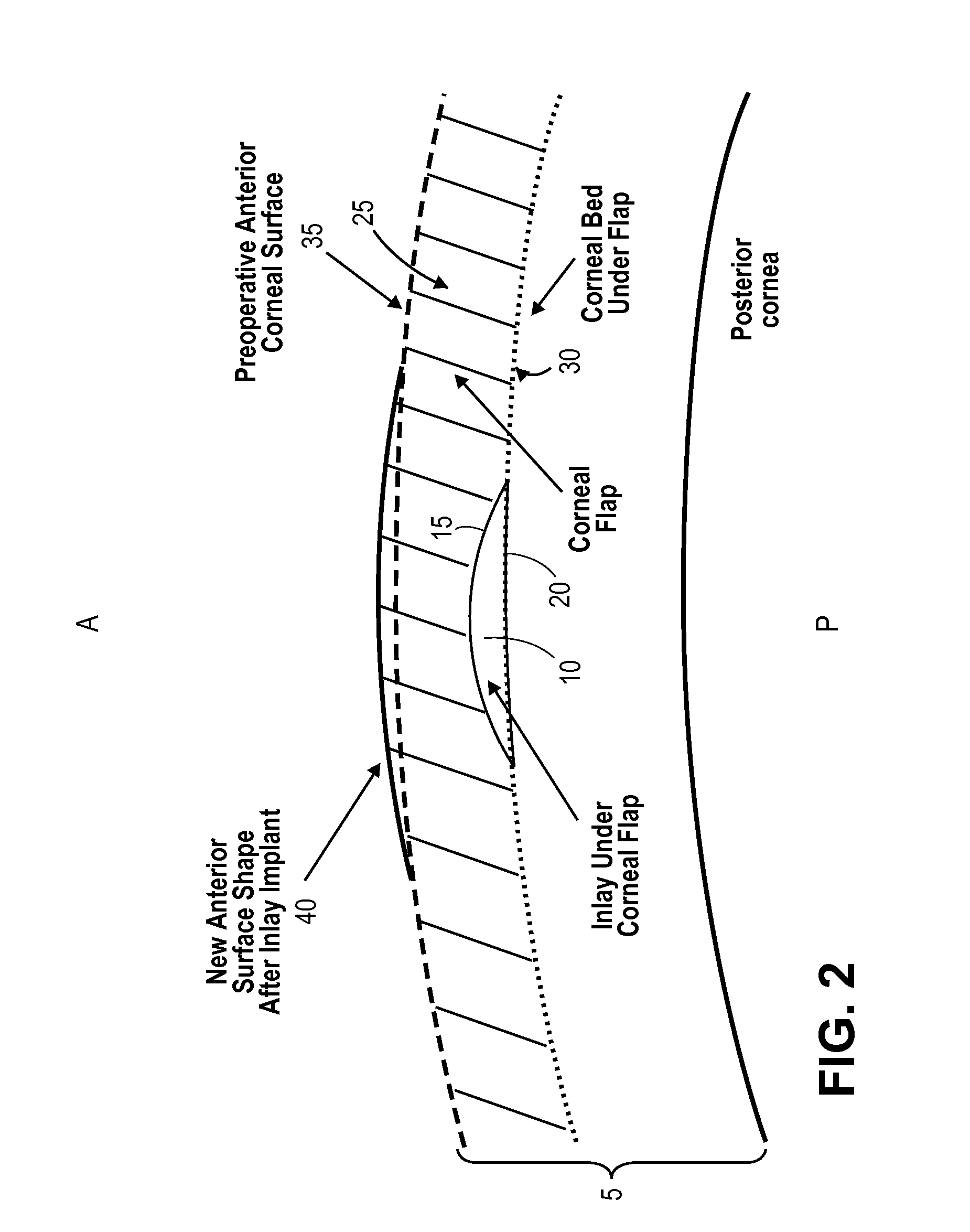 Corneal inlay design and methods of correcting vision