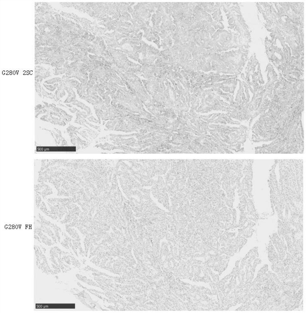 Novel pathogenic mutation sites of fumarase genes leading to HLRCC