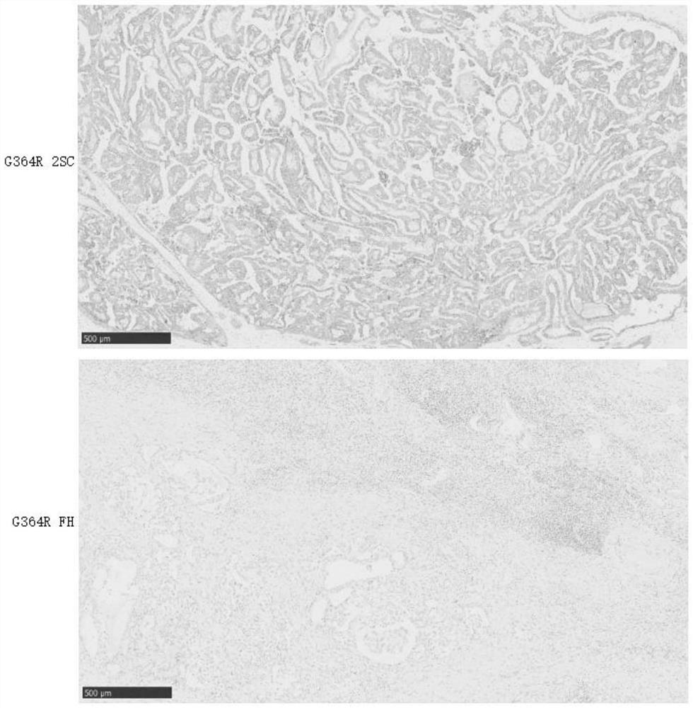 Novel pathogenic mutation sites of fumarase genes leading to HLRCC