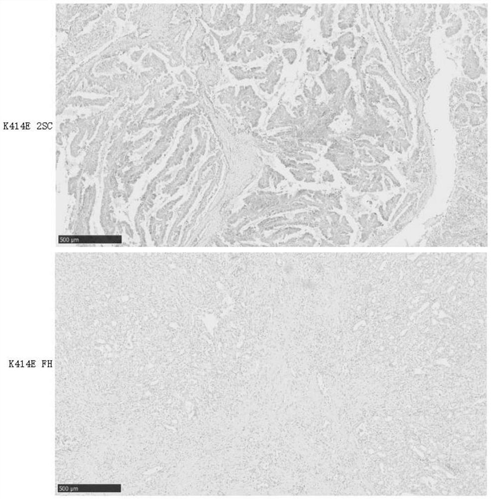 Novel pathogenic mutation sites of fumarase genes leading to HLRCC