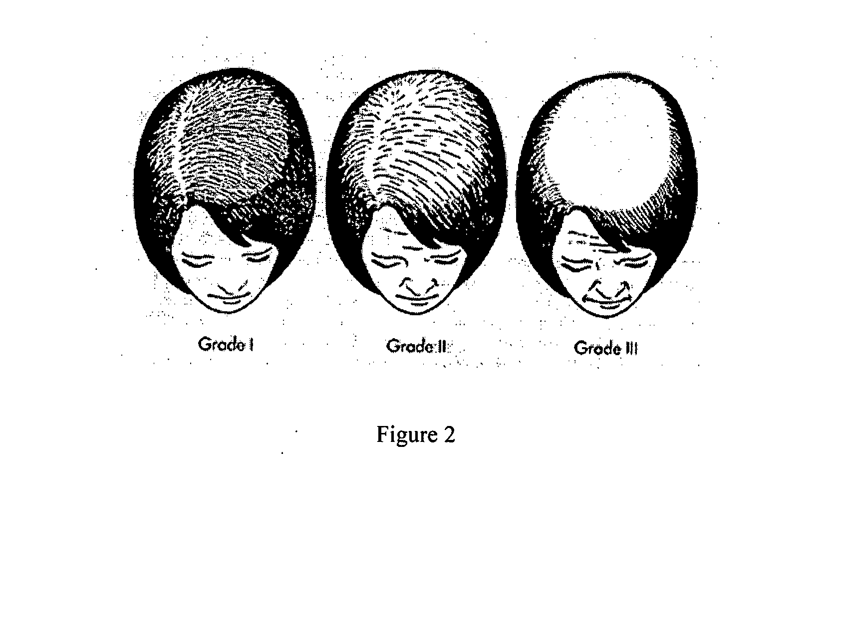 Composition and method for an intradermal hair growth solution
