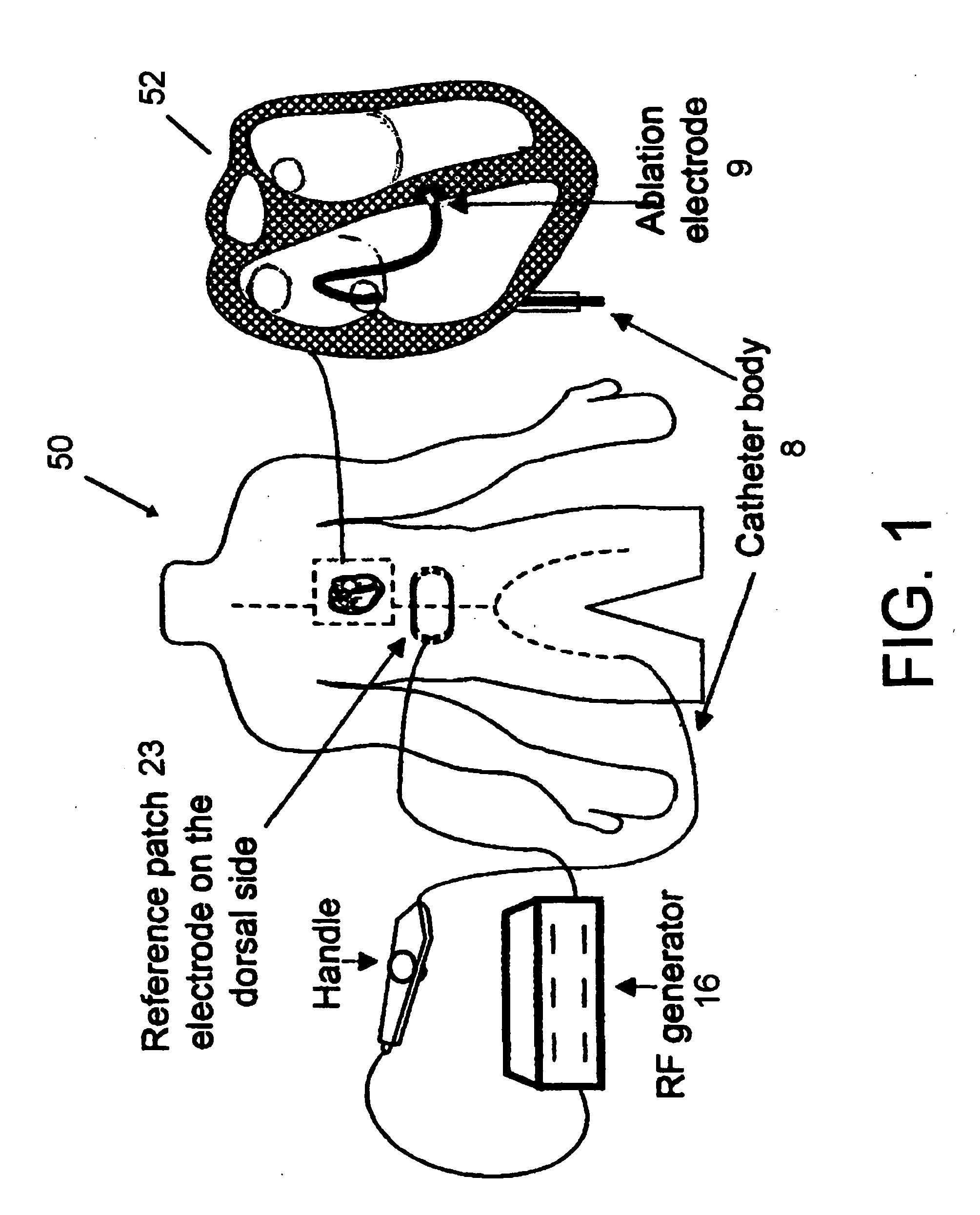 Method and system for monitoring atrial fibrillation ablations with an ablation interface device