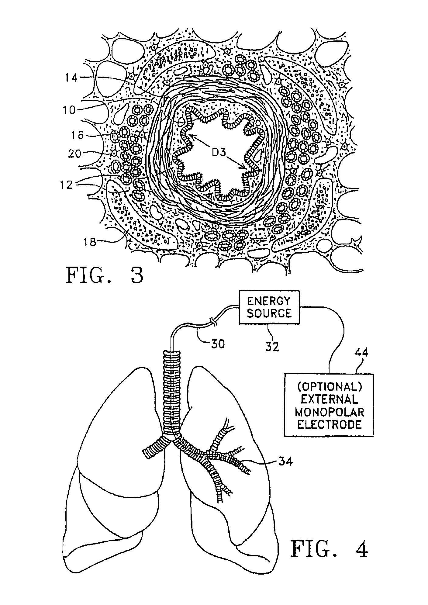 Devices for modification of airways by transfer of energy