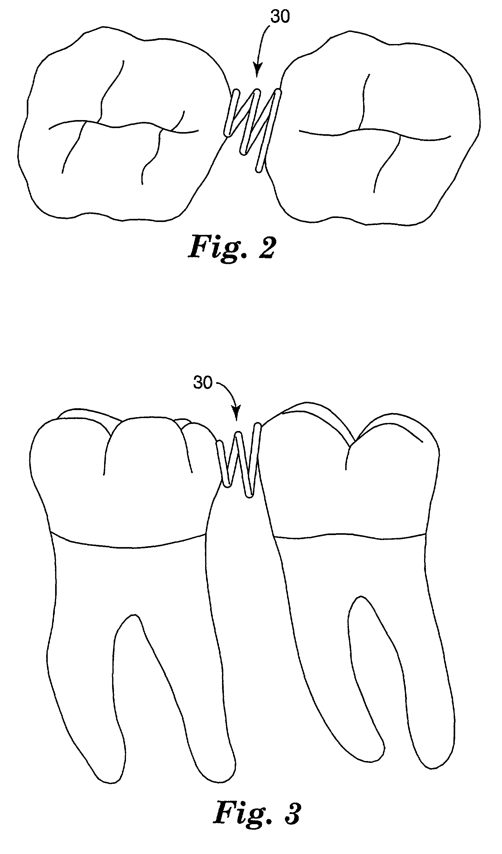 Orthodontic separators