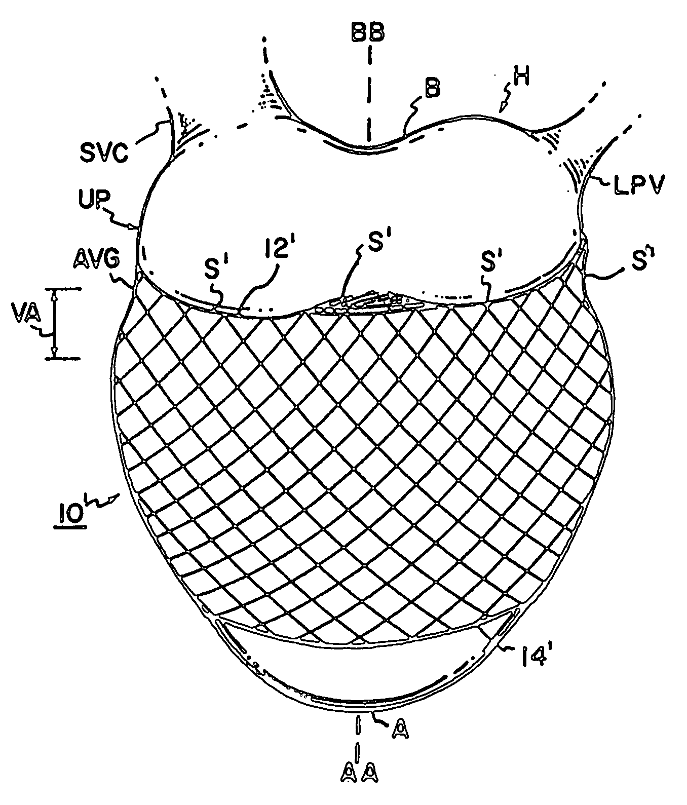 Compliant cardiac support device
