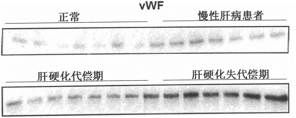 Biomarkers VWF and ADAMTS13 and use thereof in liver cirrhosis diagnostic reagents