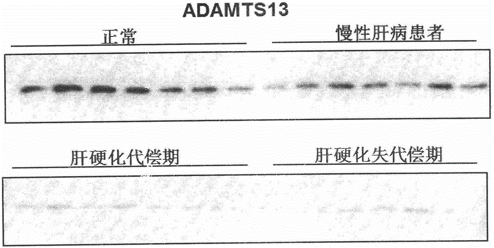 Biomarkers VWF and ADAMTS13 and use thereof in liver cirrhosis diagnostic reagents