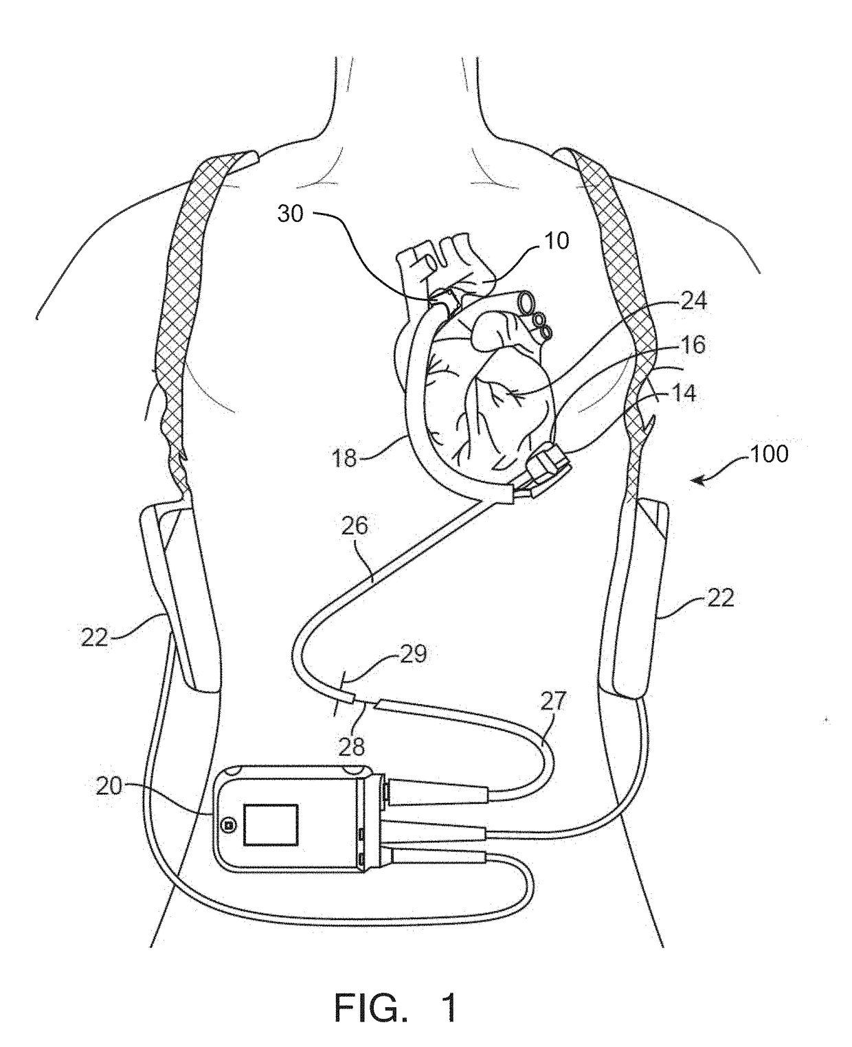 Aortic connectors and methods of use