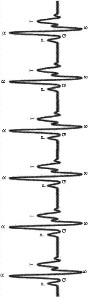 Method For The Detecting Electrocardiogram Anomalies And Corresponding System