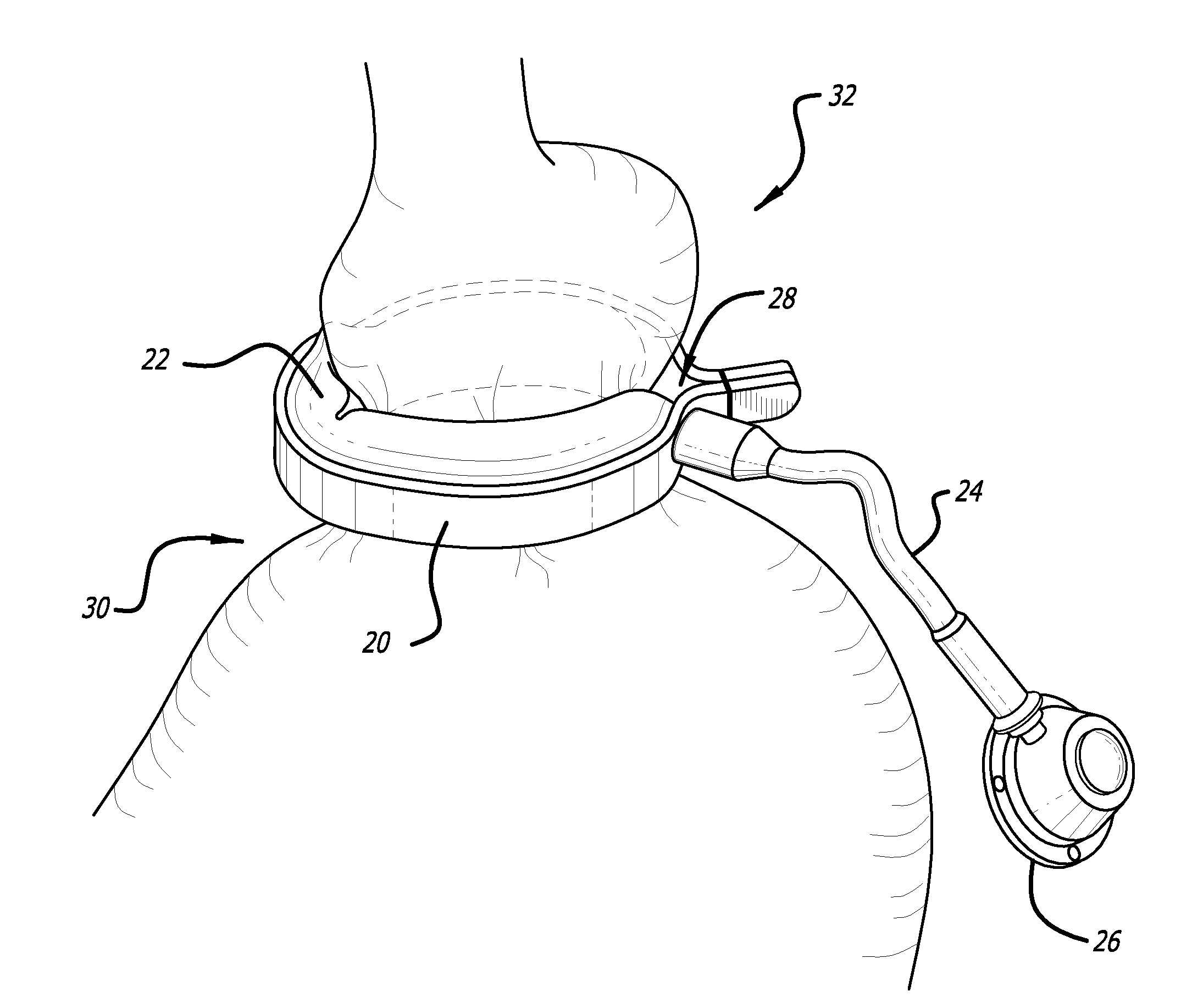 Method for increasing distensibility in a gastric band