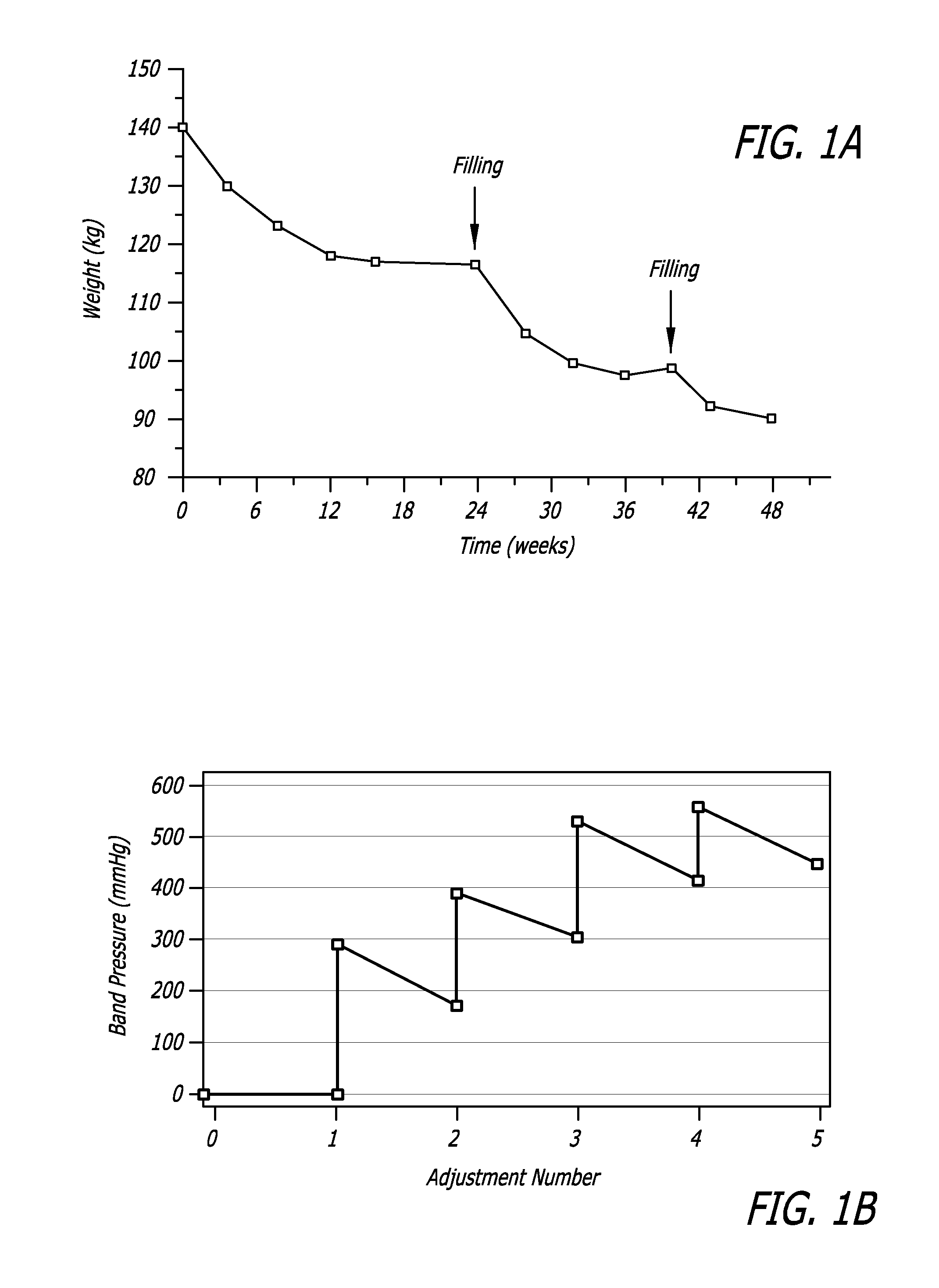 Method for increasing distensibility in a gastric band