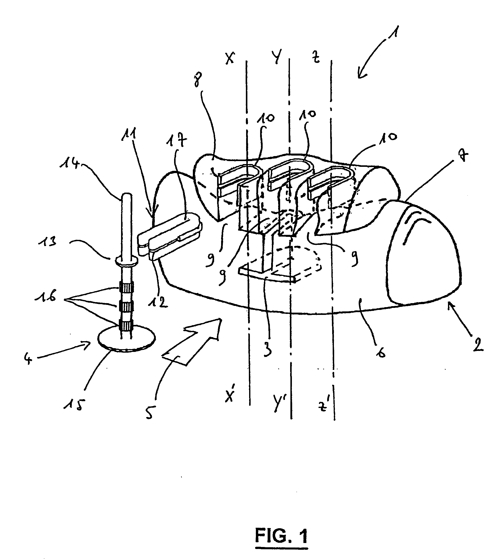 Custom-Fit Implantable Surgical Guide and Associated Milling Tool, Method for the Production and Use Thereof