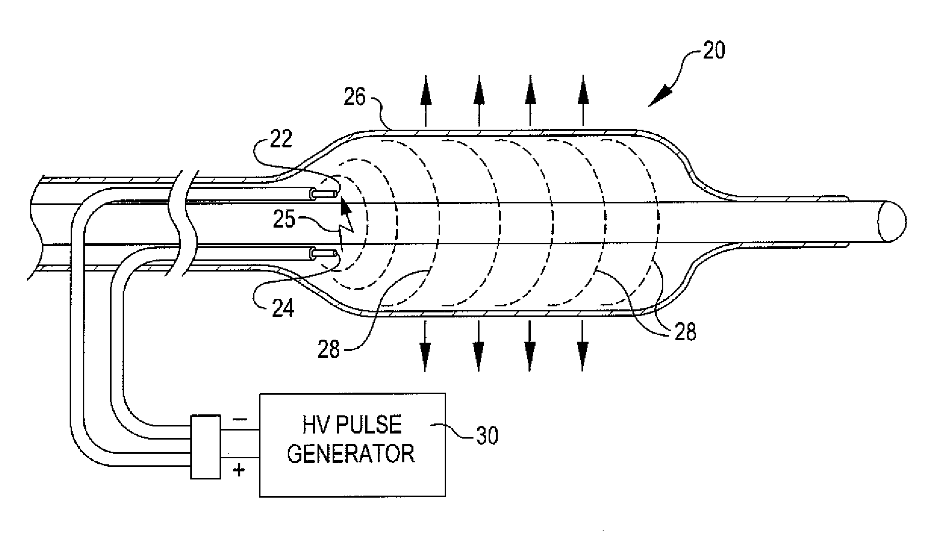 Drug delivery shockwave balloon catheter system