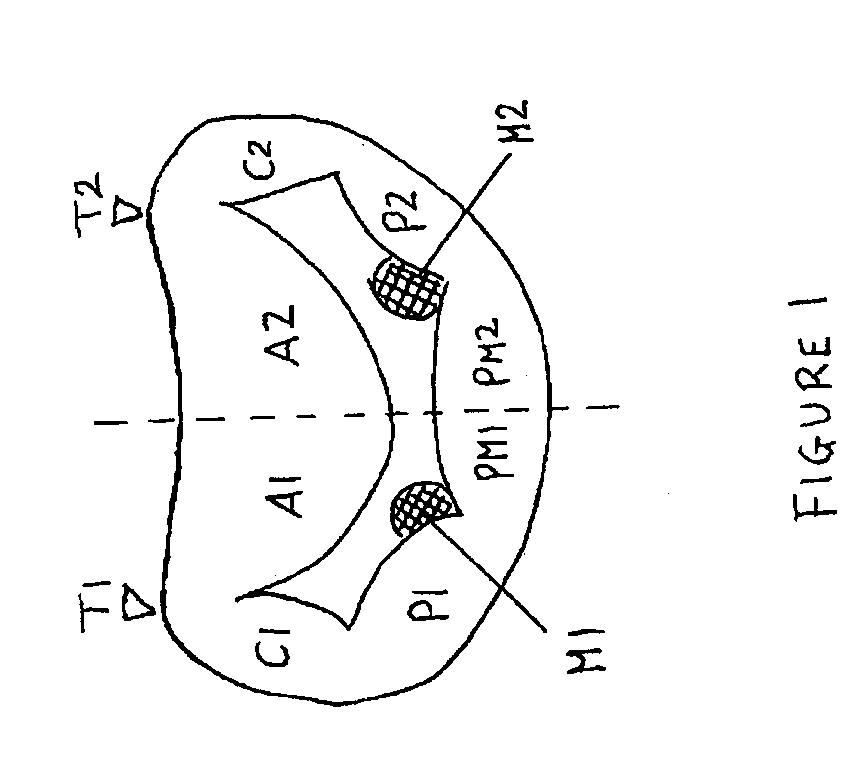 Papilloplasty band and sizing device
