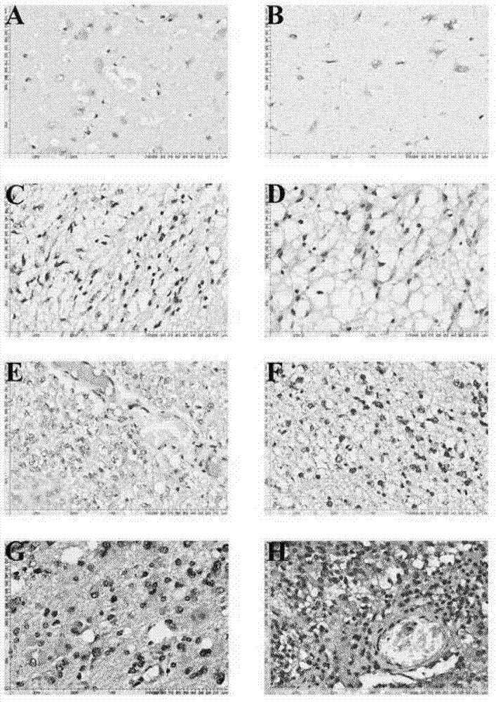 Method for detecting expression of bone sialoprotein (BSP) in brain glioma by utilizing high-throughput tissue chip