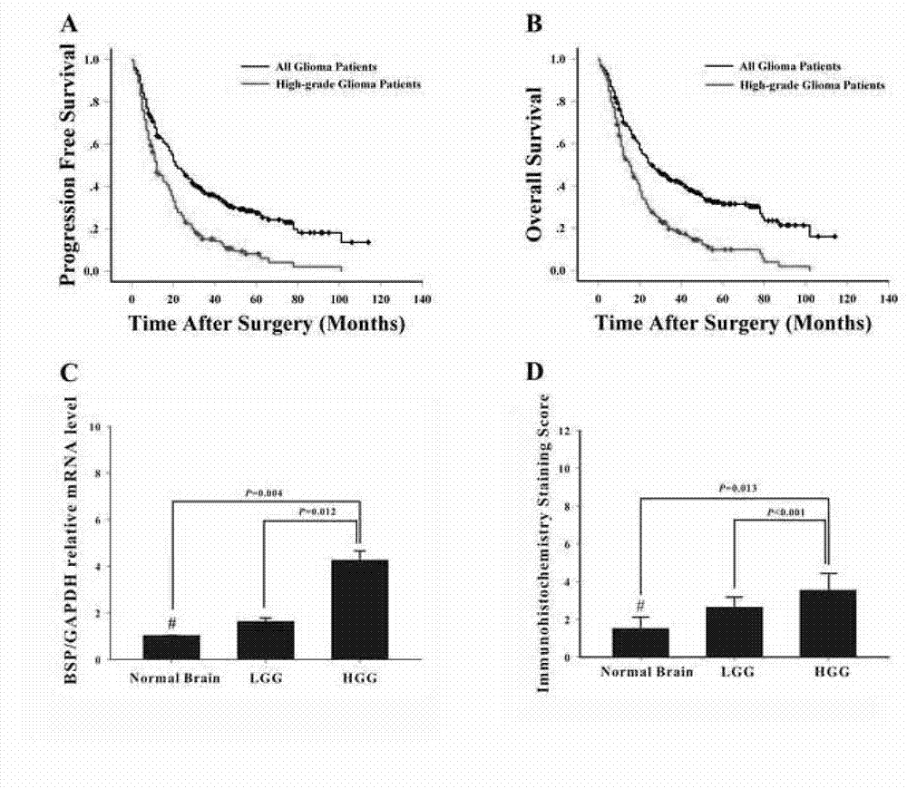 Method for detecting expression of bone sialoprotein (BSP) in brain glioma by utilizing high-throughput tissue chip