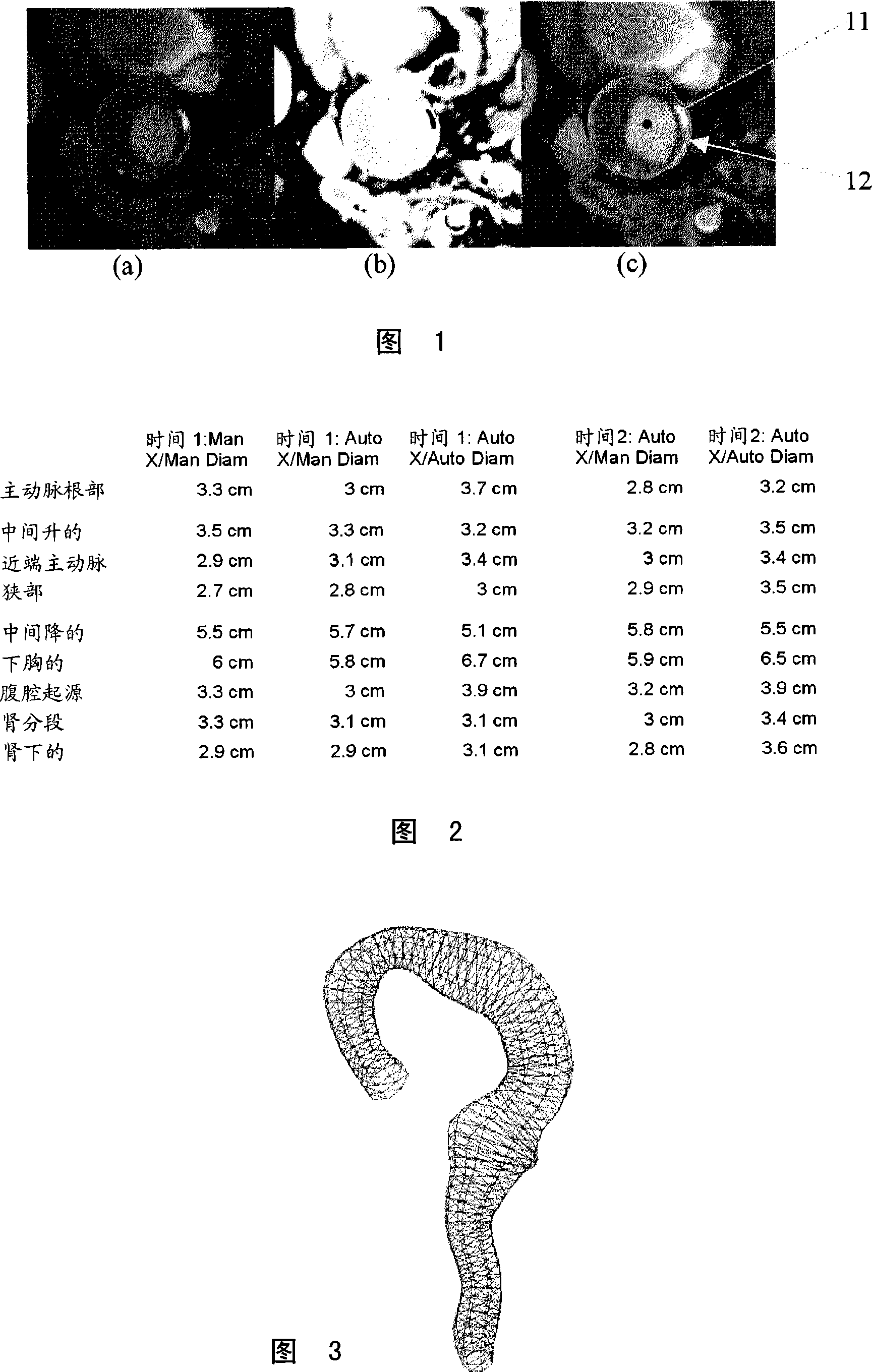 System and method for semi-automatic aortic aneurysm analysis