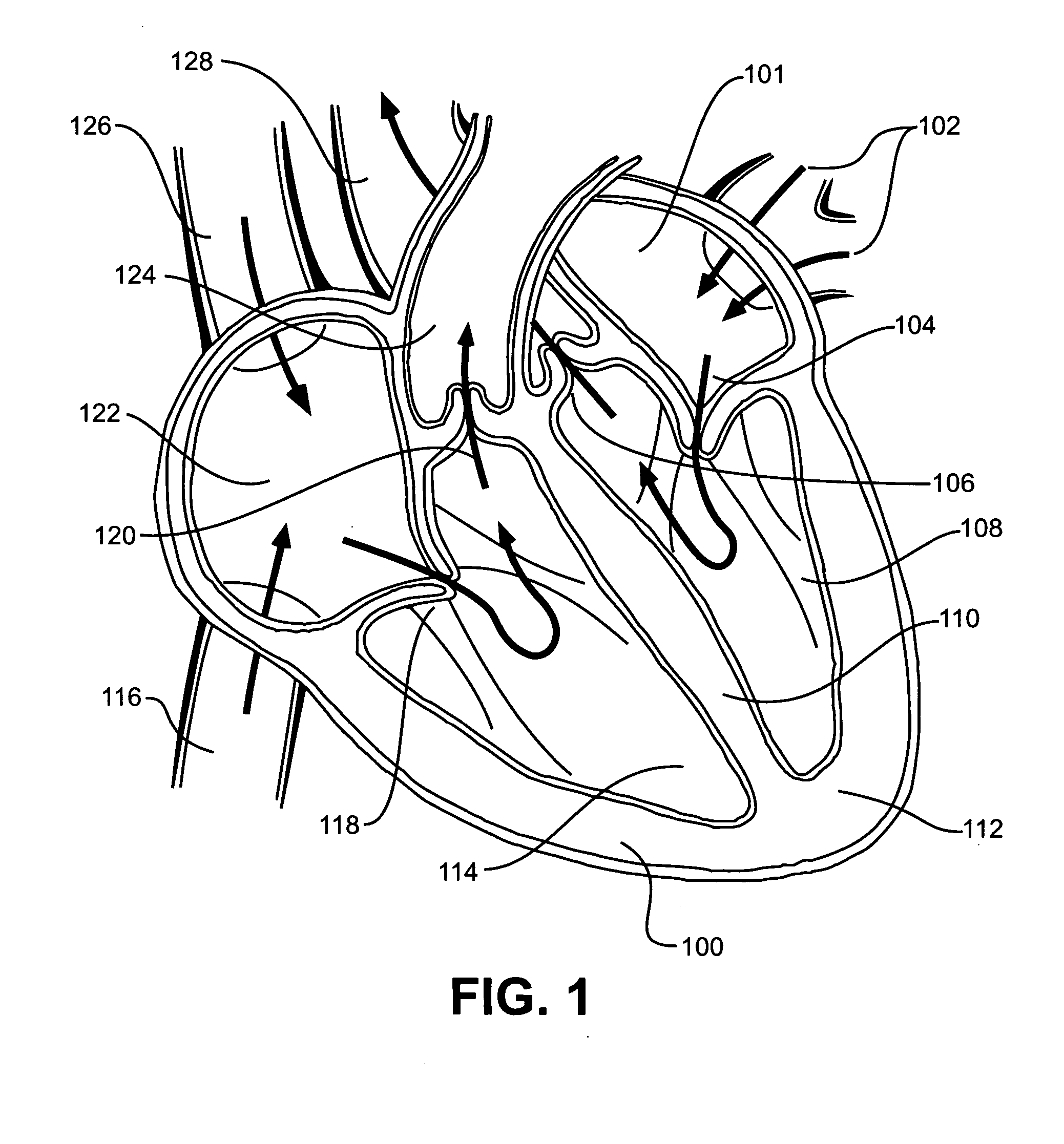 Infusion treatment agents, catheters, filter devices, and occlusion devices, and use thereof