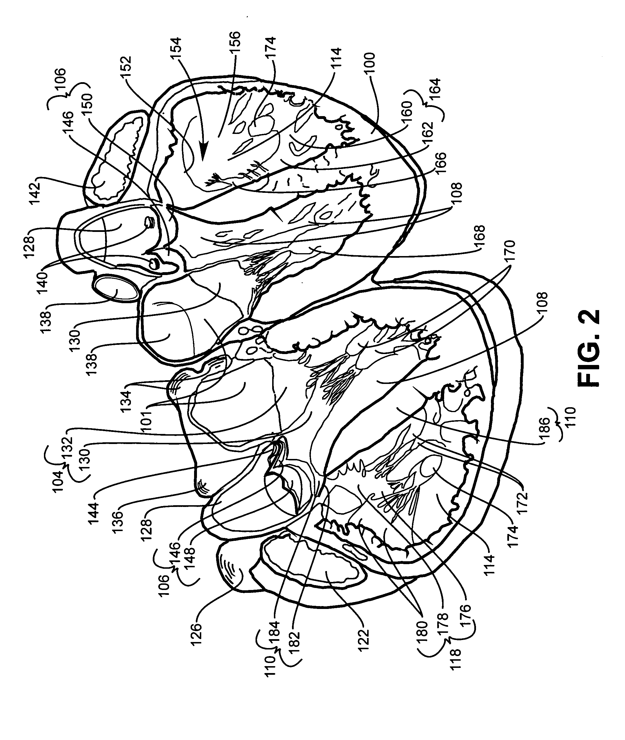 Infusion treatment agents, catheters, filter devices, and occlusion devices, and use thereof