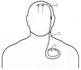 Implanted type electrical nerve stimulation system with modulation mode