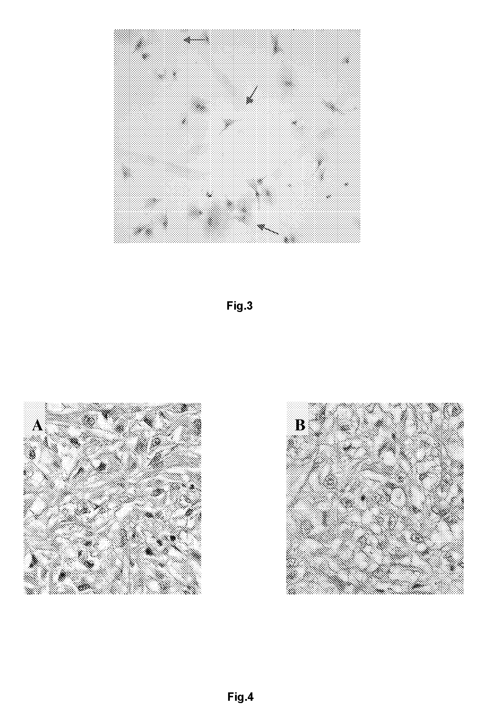 Cell line of renal sarcomatoid carcinoma in persons of Han nationality and preparation method thereof