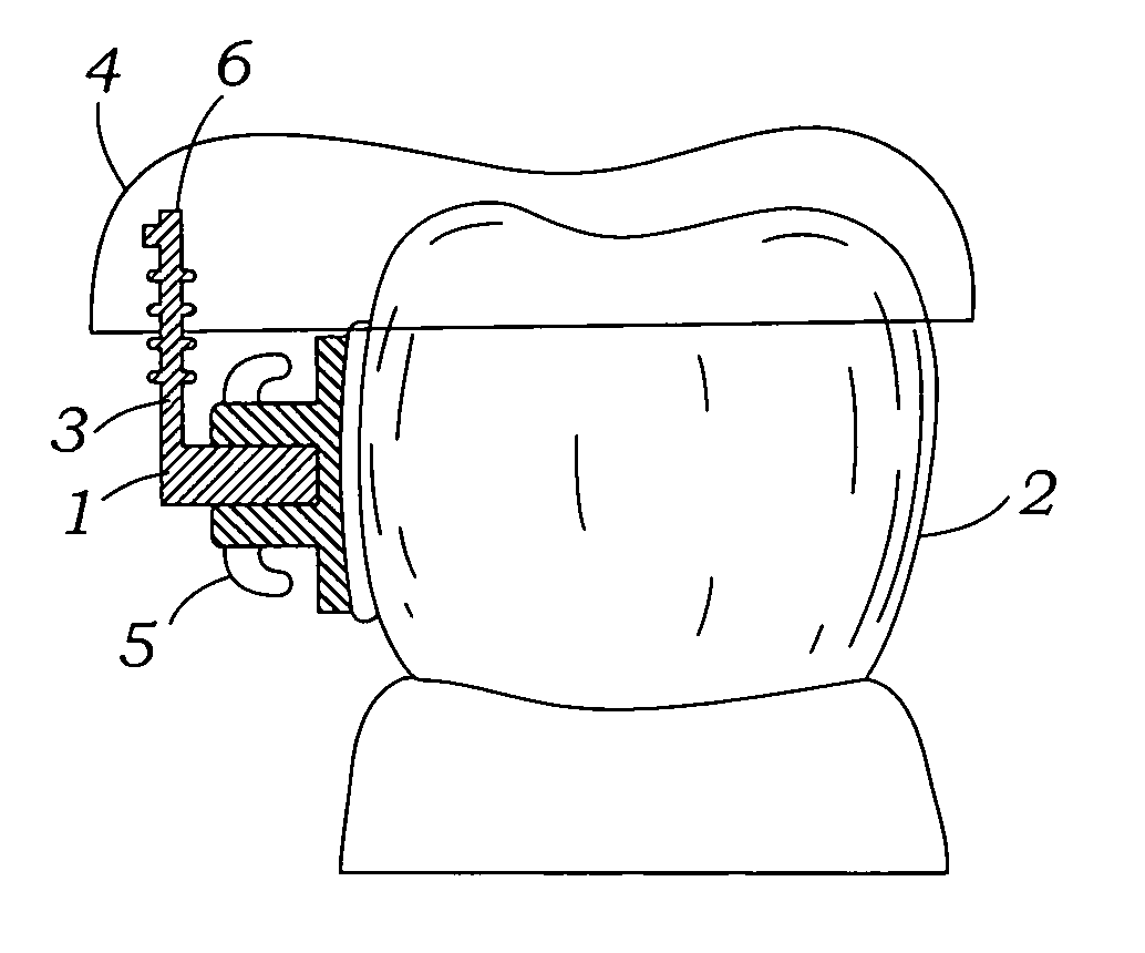 Programmable orthodontic indexing guide and bracket pin assembly and method of use