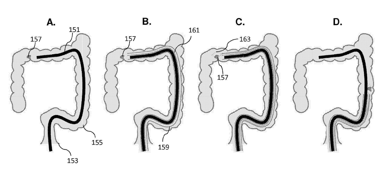 Colonic polyp removal