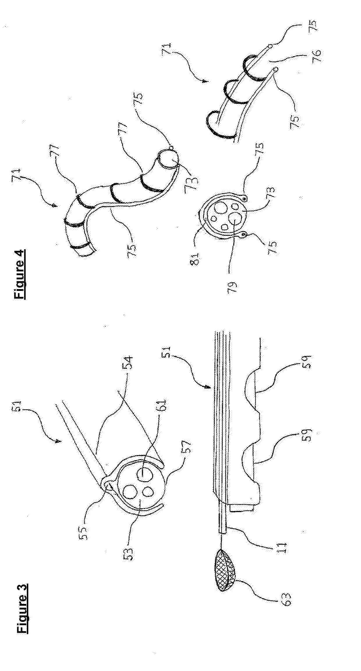 Colonic polyp removal