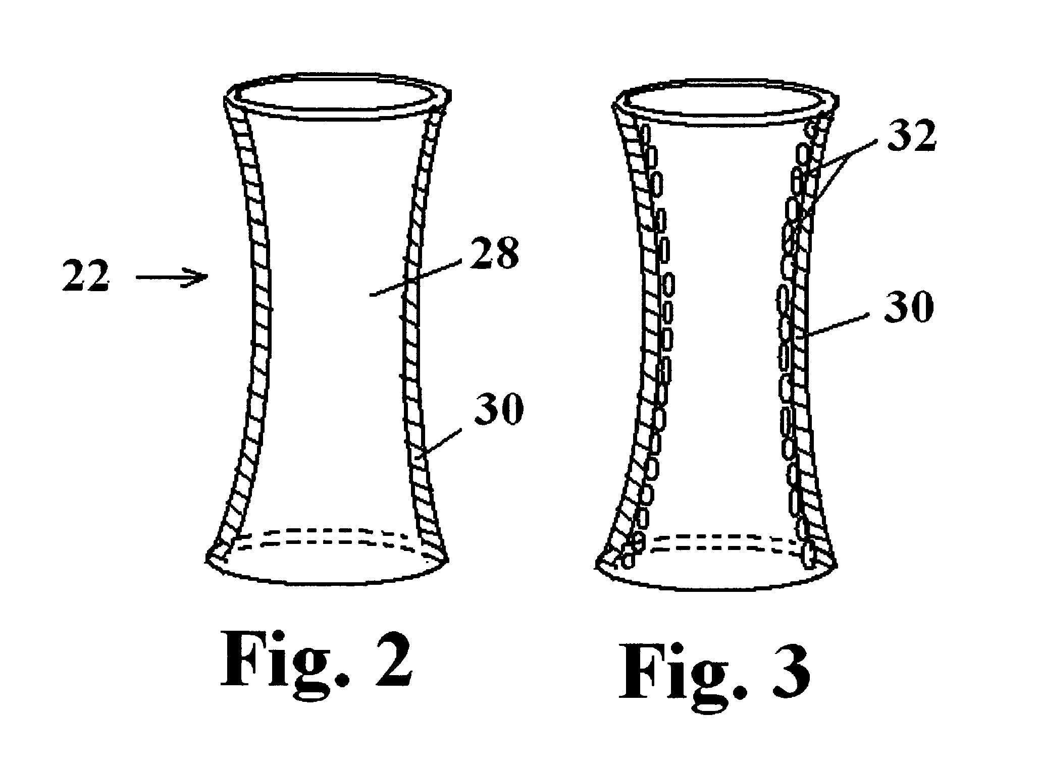 Delivery system and urethra stent for enlarged prostates and method