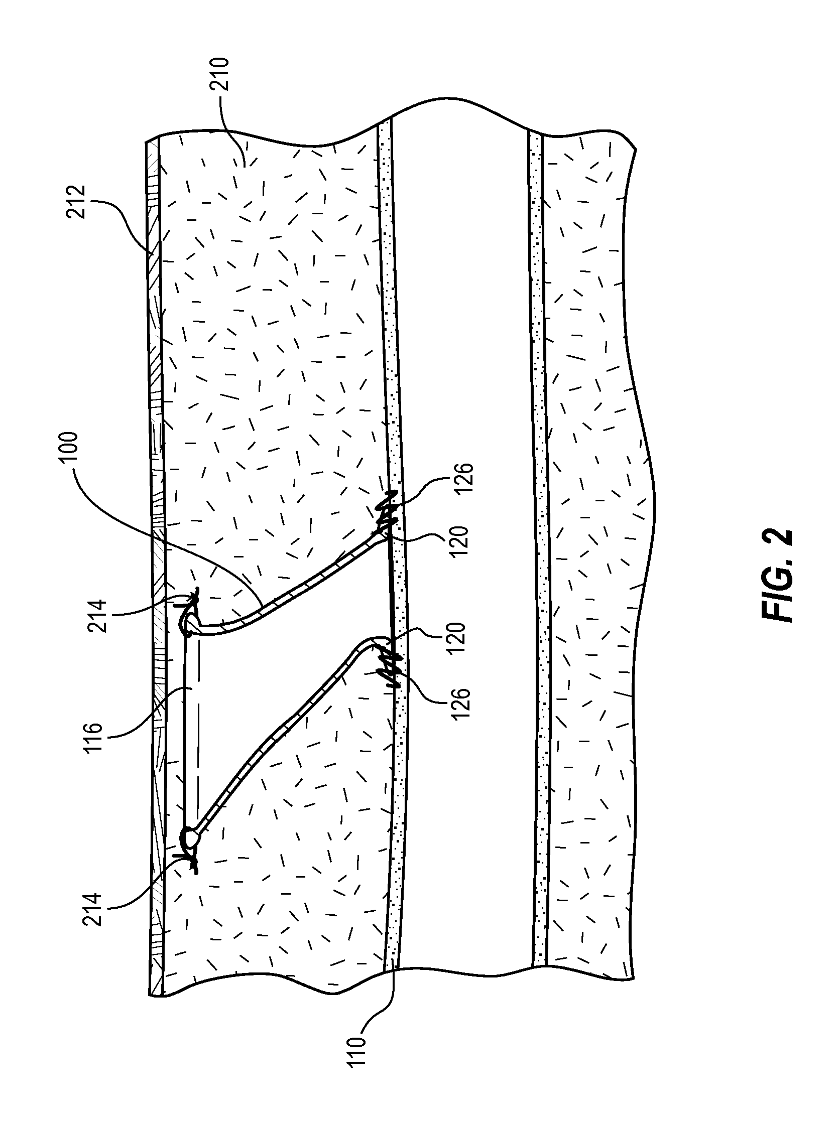 Repetitive entry conduit for blood vessels