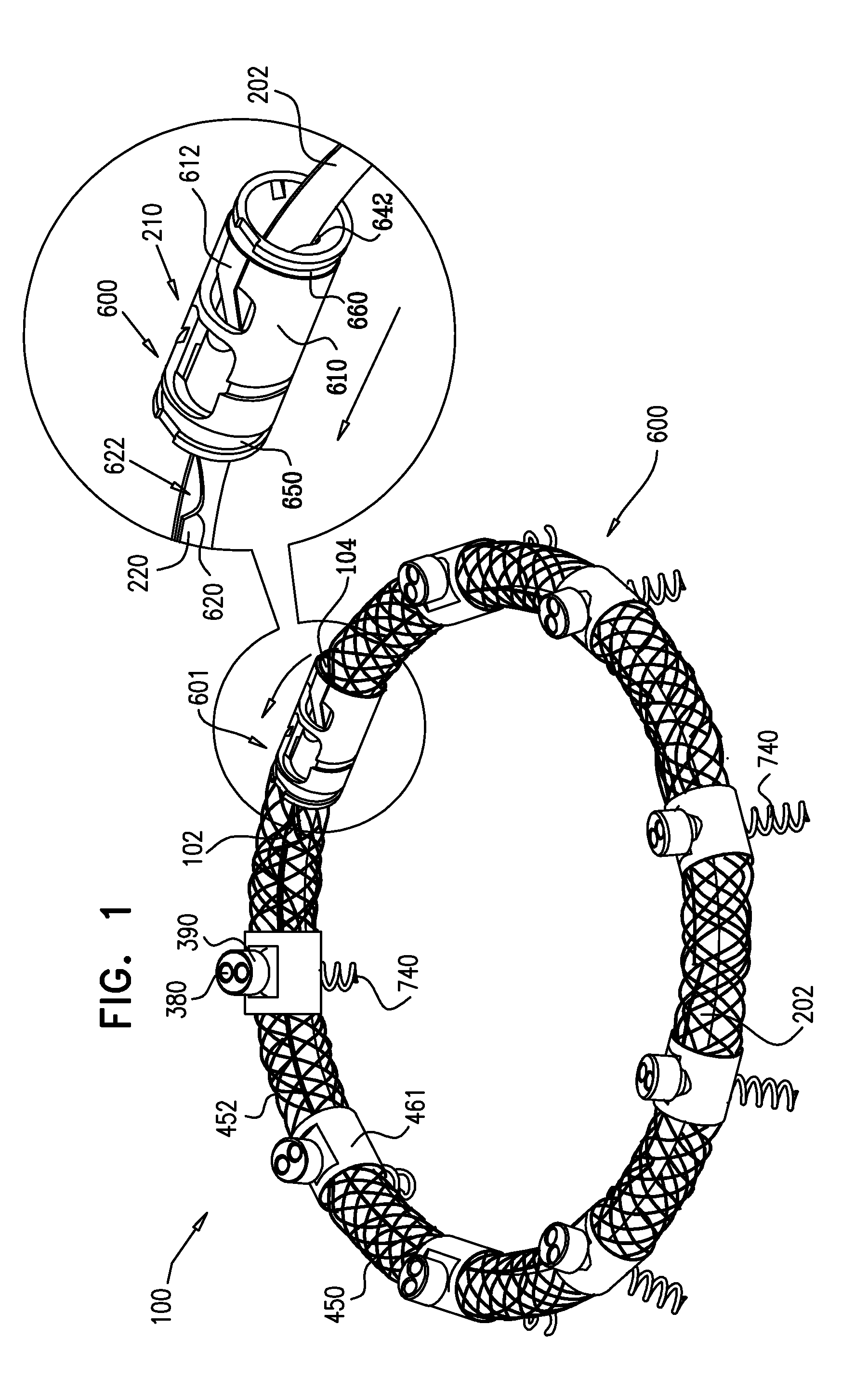 Implant and anchor placement