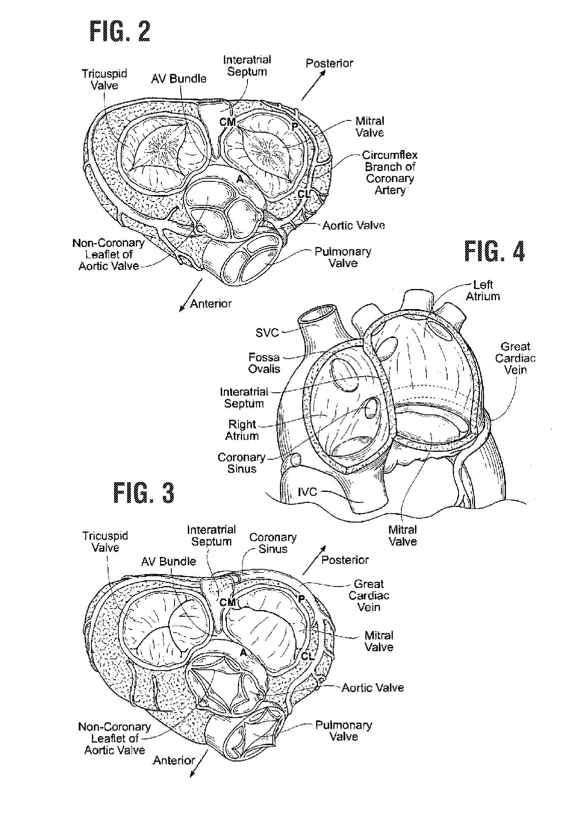 Rapidly deployable surgical heart valves