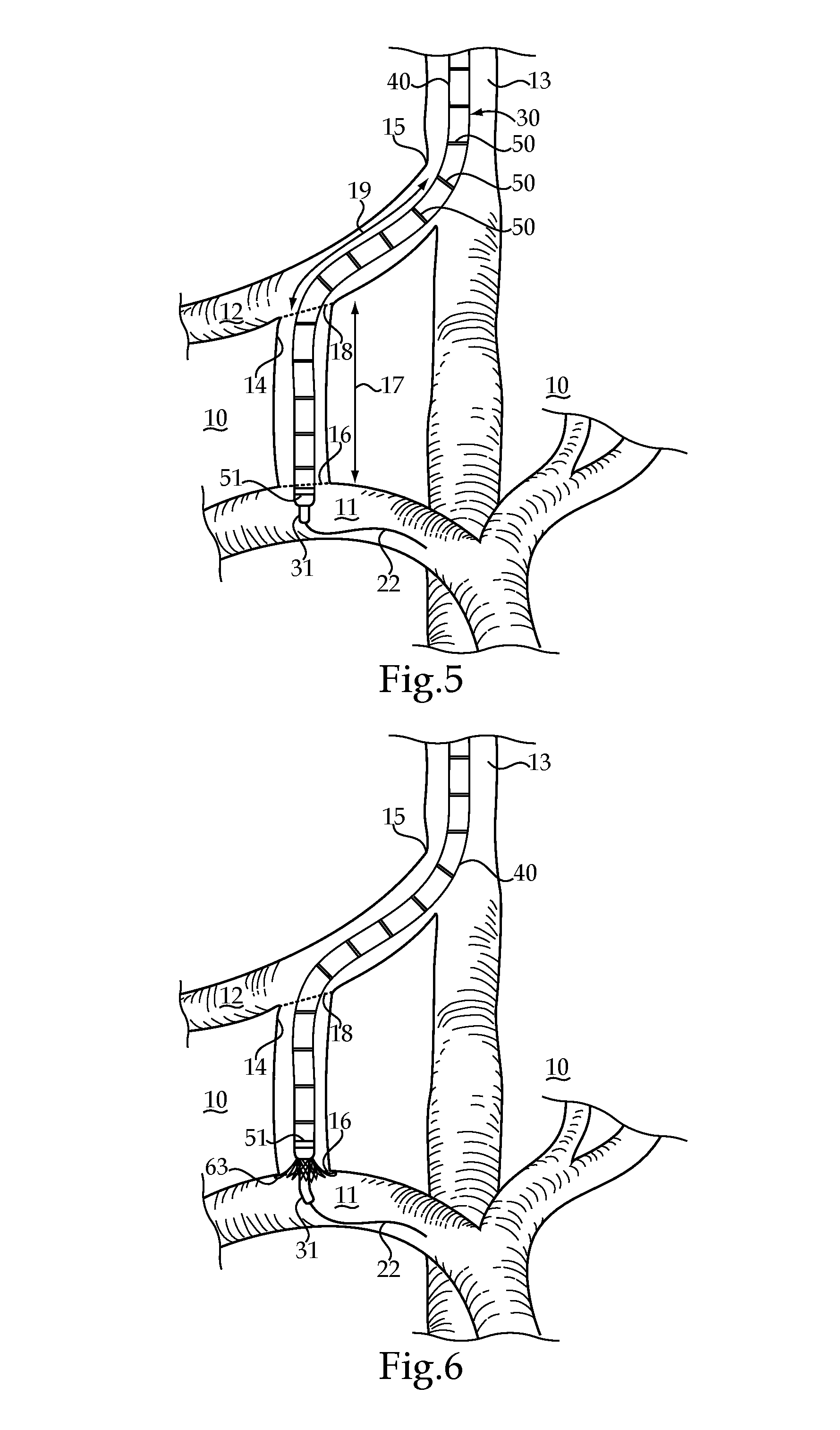 Duet stent deployment system and method of performing a transjugular intrahepatic portosystemic shunting procedure using same