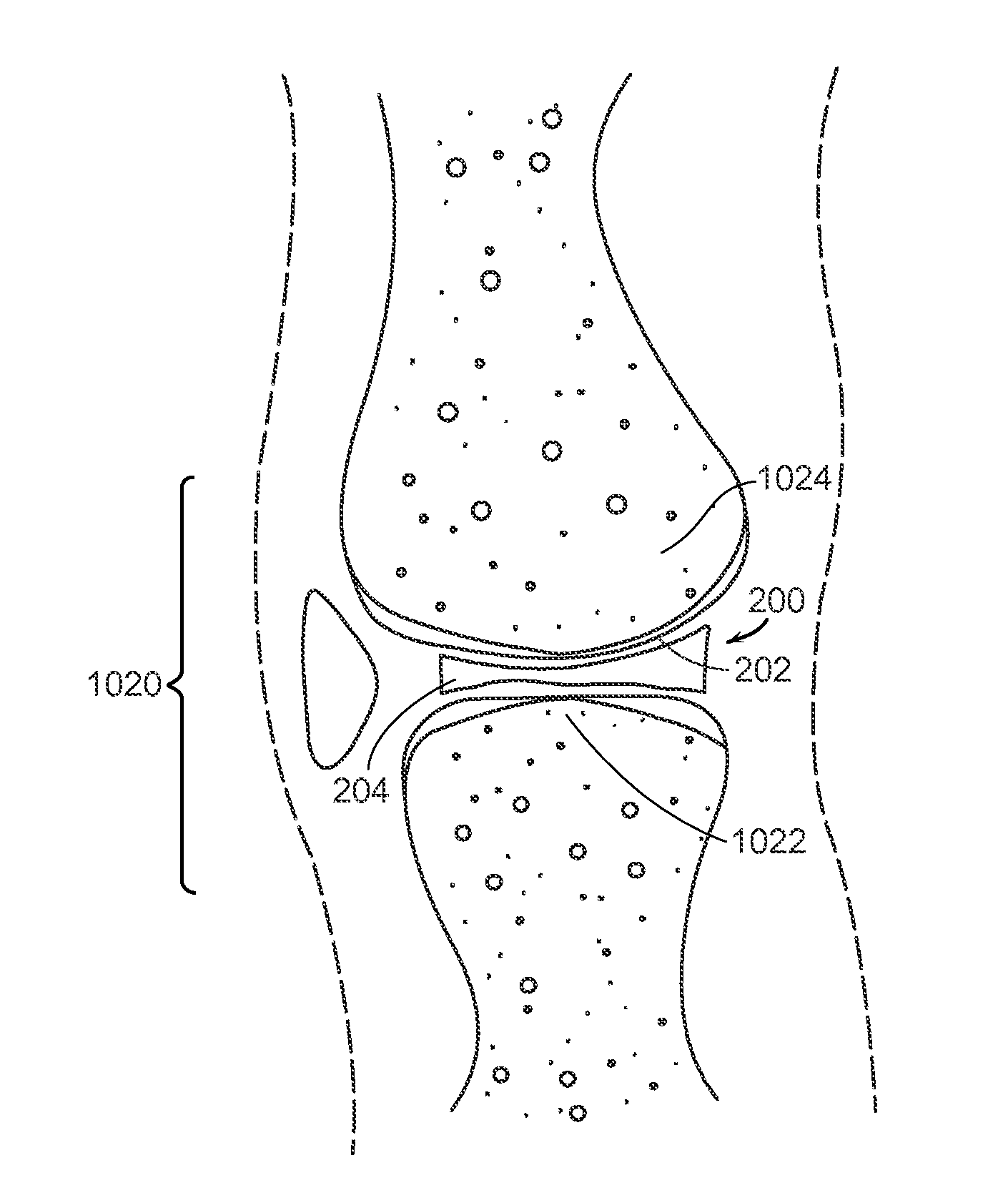Patient Selectable Knee Joint Arthroplasty Devices