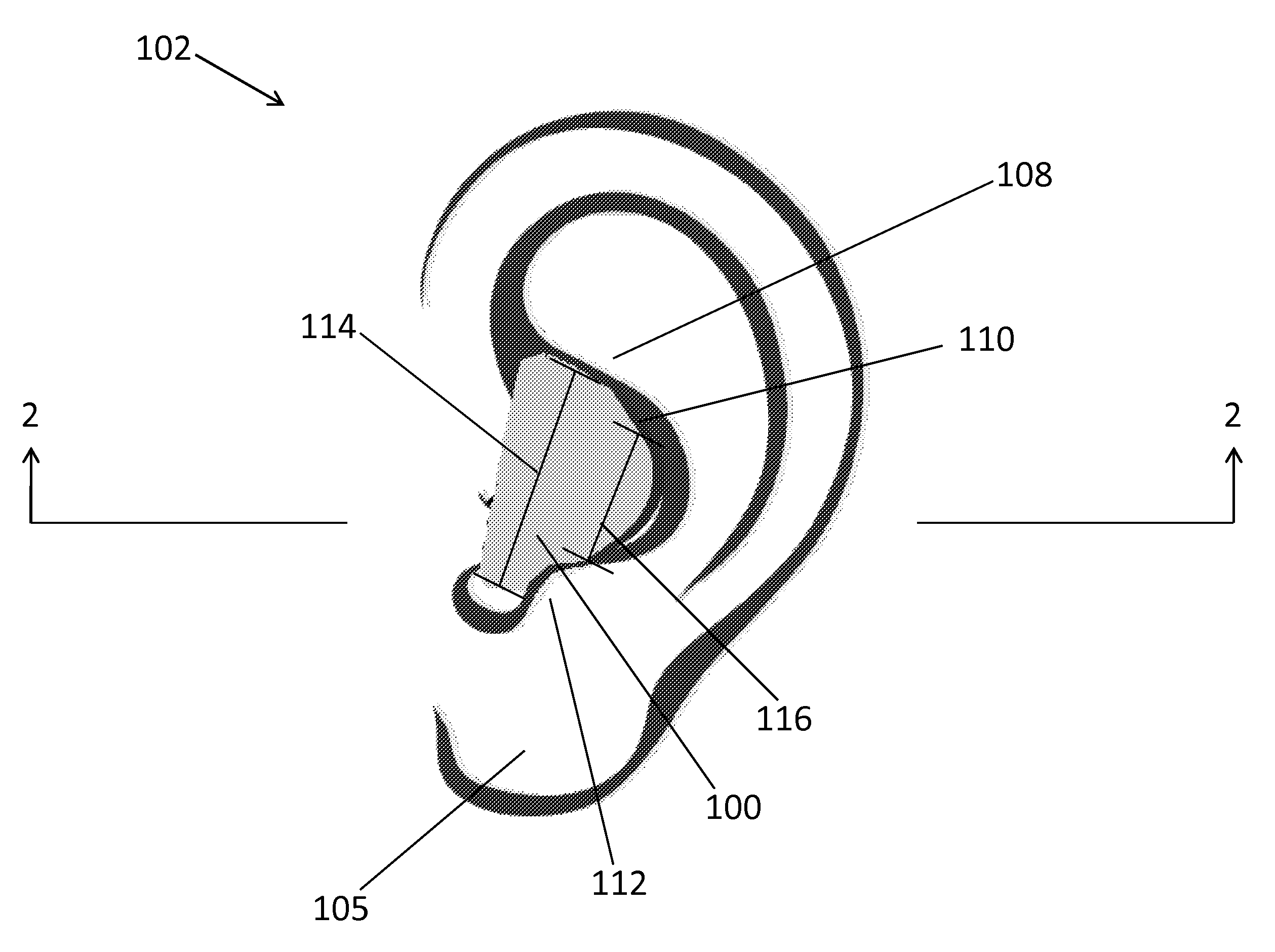 Method and apparatus for ear protection